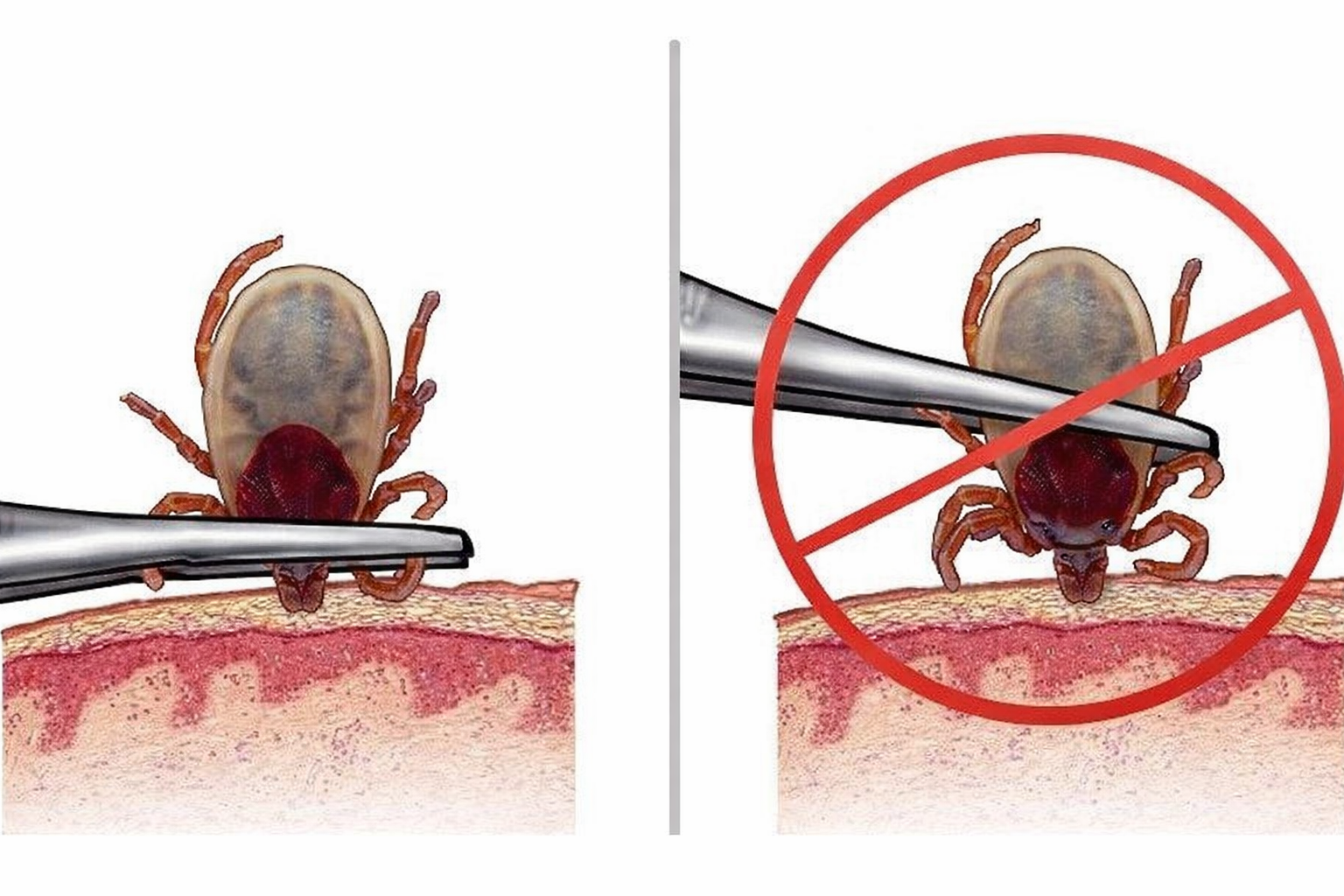 Кърлежи - най-важното, което трябва да знаем